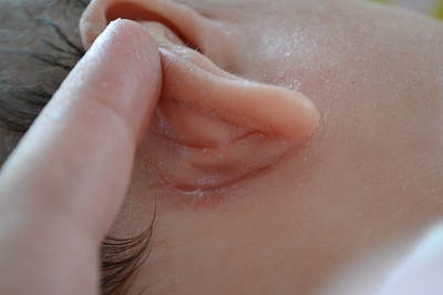 ラッチ 比類のない 省略する 赤ちゃん 耳 の 後ろ 湿疹 Ftrmag Jp